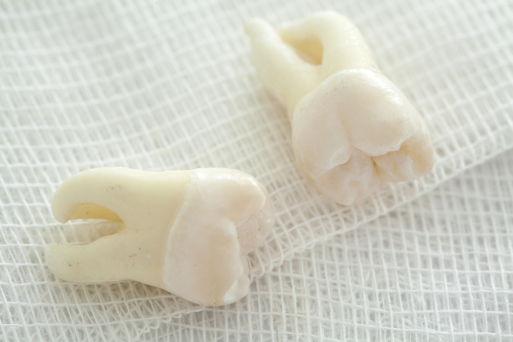 Common Myths Surrounding Wisdom Tooth Removal