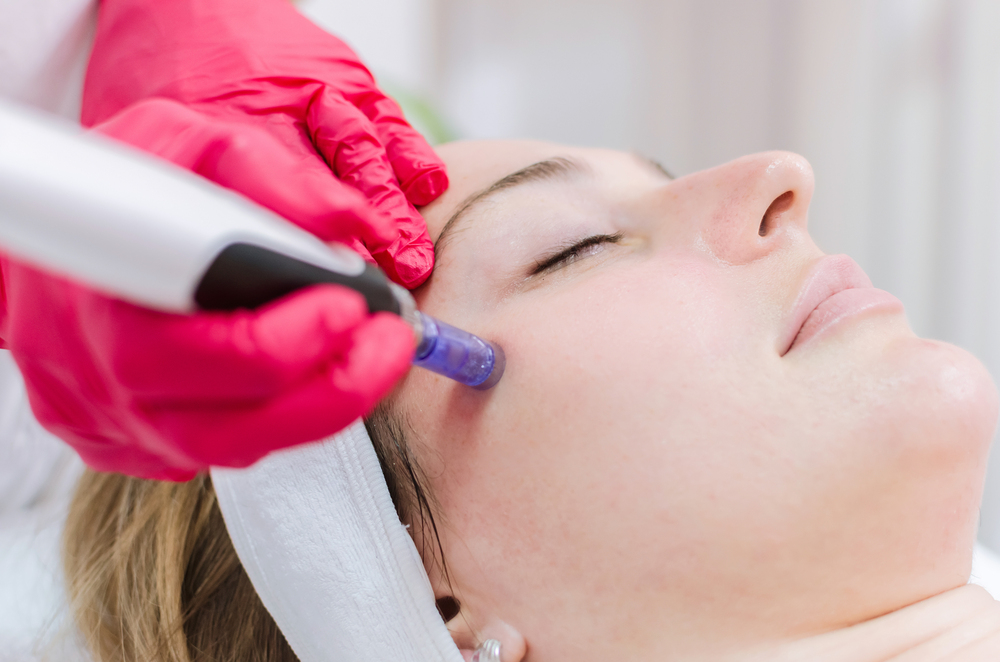 What Are the Benefits and Results of Microneedling Treatments in Toronto