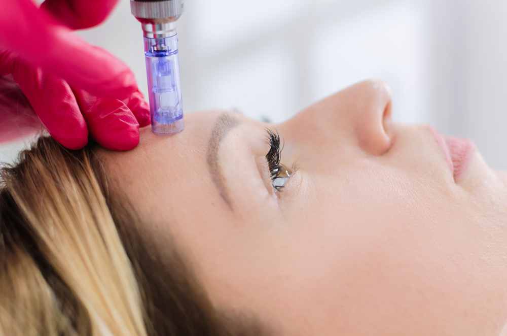 What Are the Benefits and Results of Microneedling Treatments in Toronto