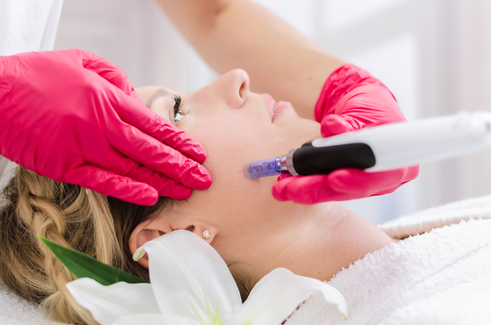 What Are the Benefits and Results of Microneedling Treatments in Toronto