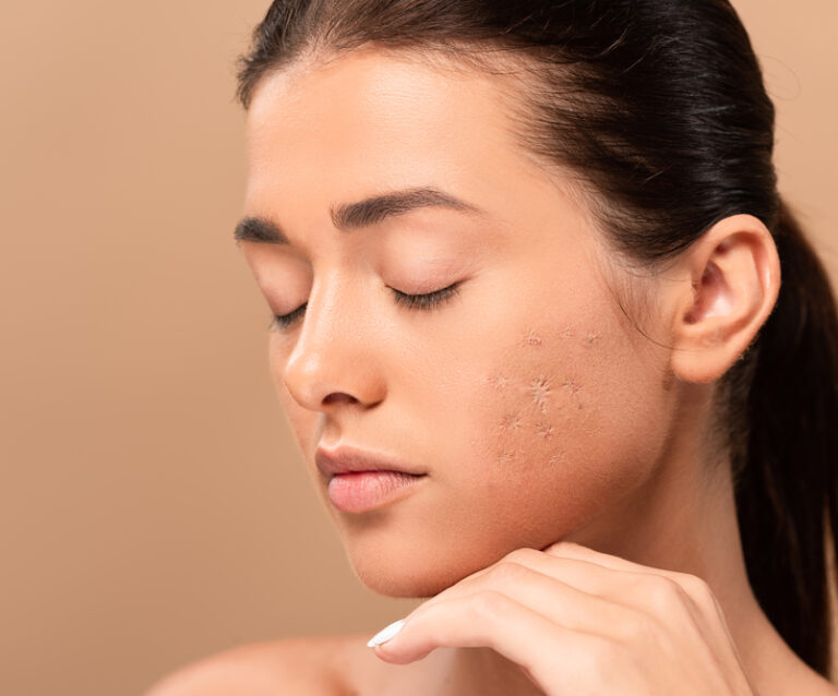 How Dealing with Acne Scars Can Improve Your Skin's Texture