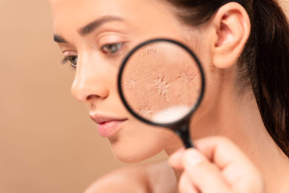 How Dealing with Acne Scars Can Improve Your Skin's Texture