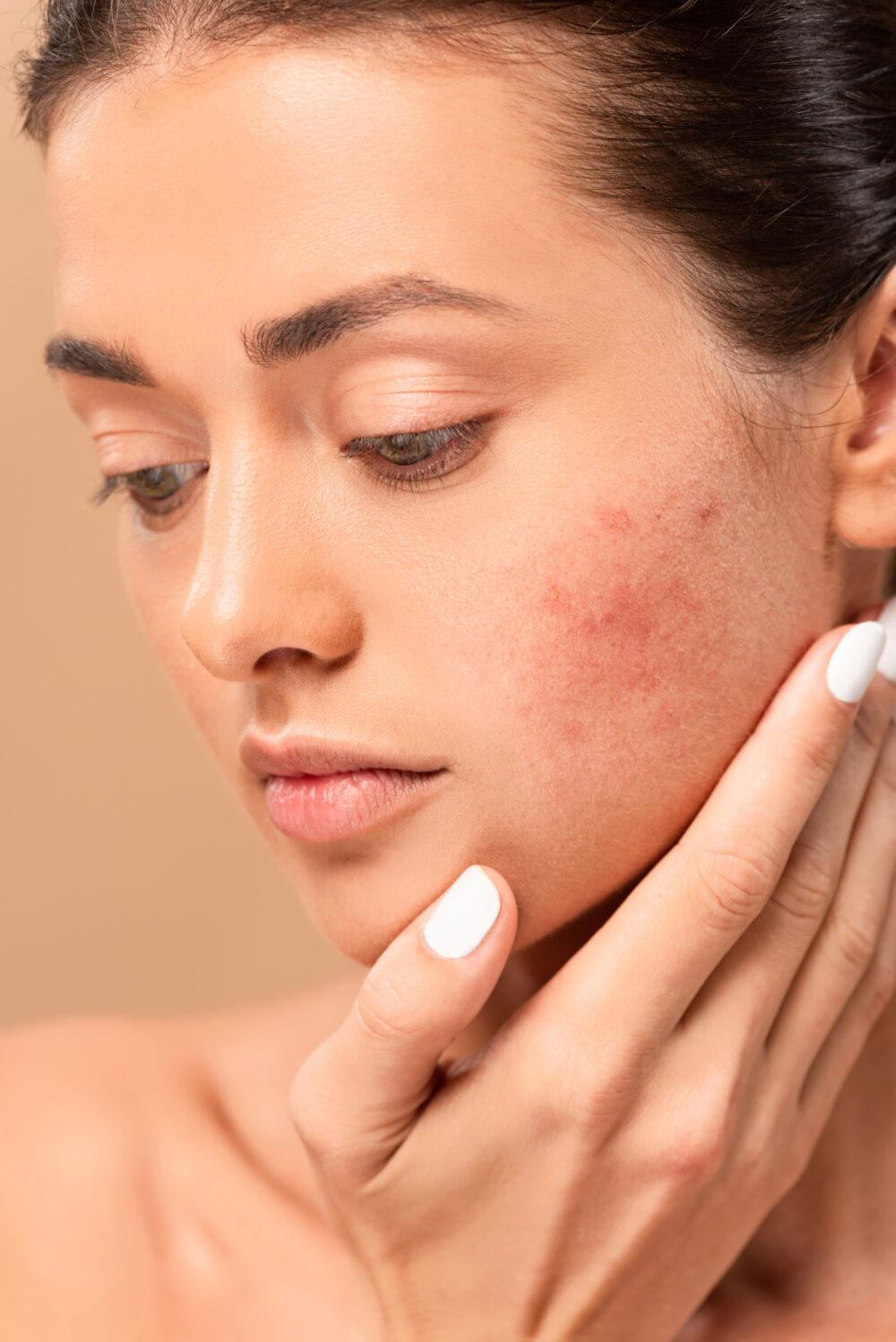 How Dealing with Acne Scars Can Improve Your Skin's Texture