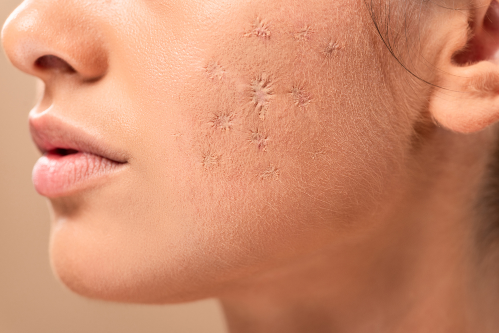 How Dealing with Acne Scars Can Improve Your Skin's Texture