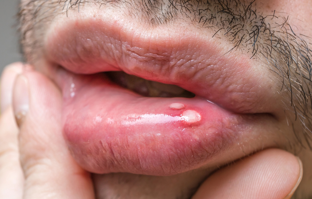 Why Do People Get Canker Sores?