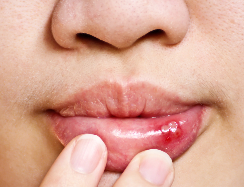 Why Do People Get Canker Sores?