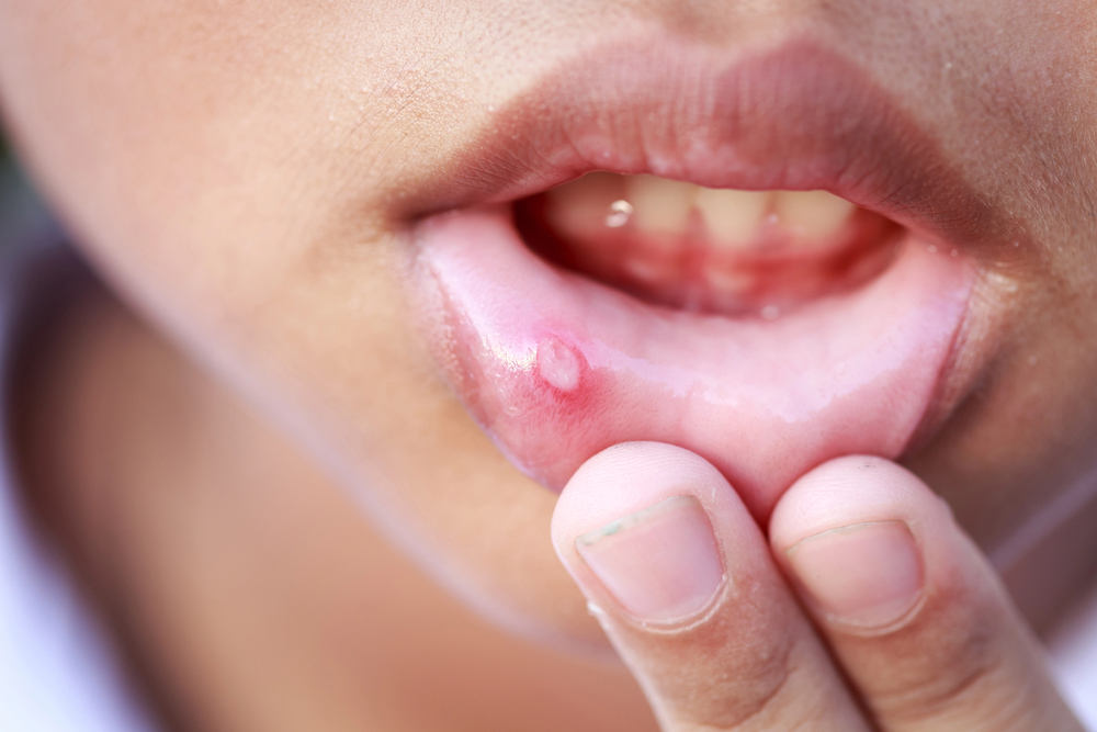 Why Do People Get Canker Sores?